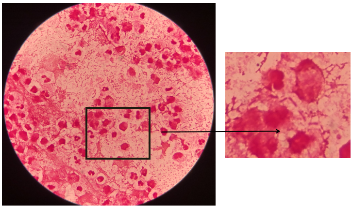 高毒力肺炎克雷伯菌致脑脓肿一例