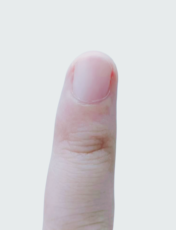 医生提醒:指甲出现这个变化,可能是癌变!别不当回事!