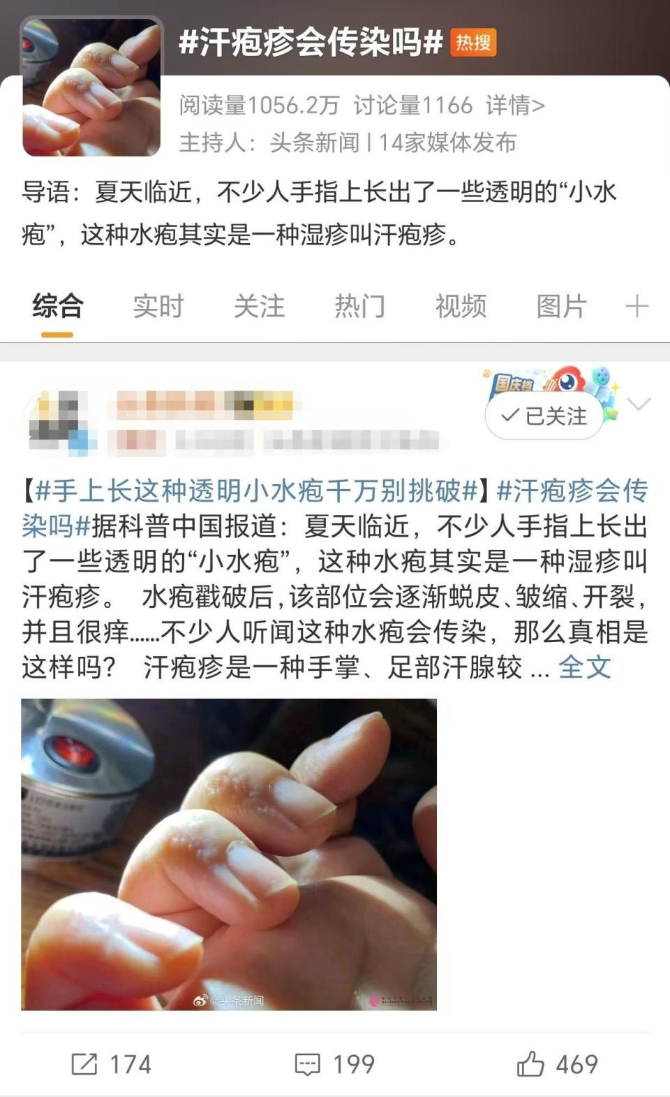 汗疱疹是怎么引起的图片