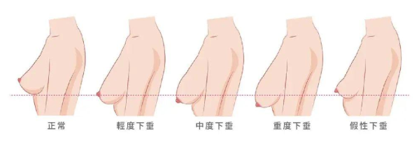 哺乳后,胸部下垂怎么办?别担心,还有救!