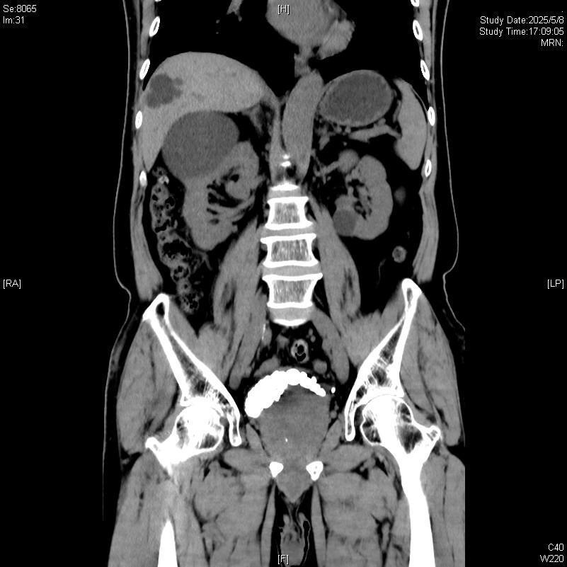 ct检查结果显示李大爷膀胱内布满了30余枚结石,犹如月球表面的环形山
