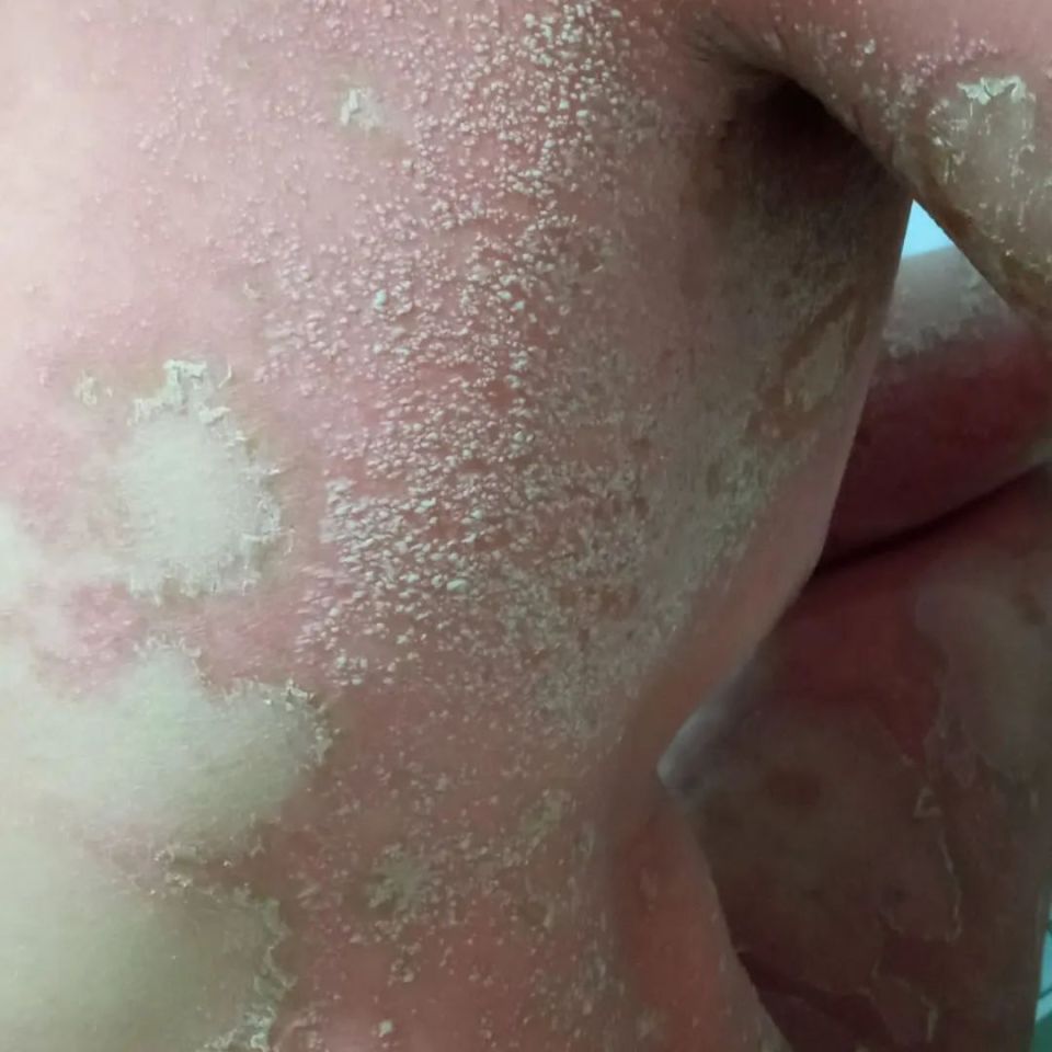 【岐黄科普】皮肤"顽症"并不可怕,皮肤科专家带您正确认识银屑病