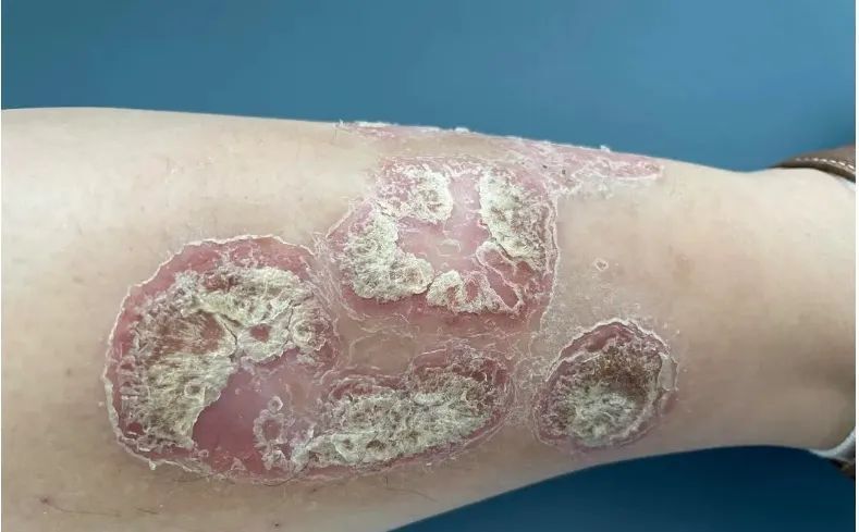 银屑病治疗创新疗法-古塞奇尤单抗-腾讯新闻