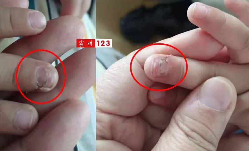 我儿子现在才一周半,事后我联系物业并未得到回复,直到孩子伤口有好转