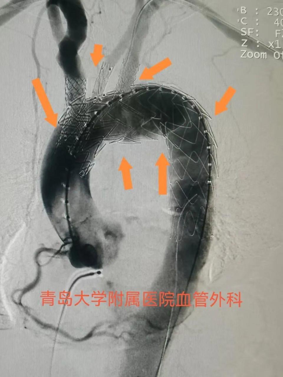 主动脉弓磁共振图像图片