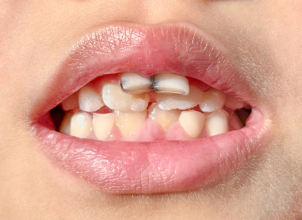 钱报健康小站|乳牙滞留,恒牙长出,孩子出现双排牙家长别急着拔