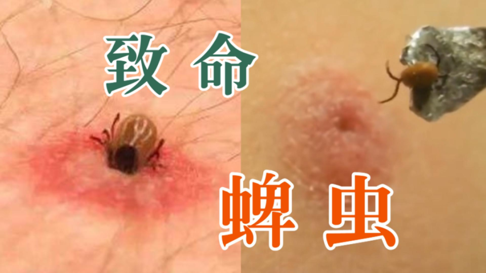 医生提醒:外出游玩要注意,警惕蜱虫咬伤