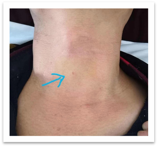 是在局麻下经超声引导,将一根仅牙签粗细的微波消融针穿刺到甲状腺