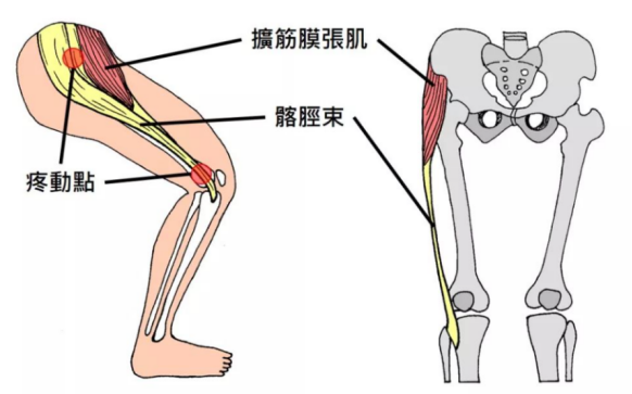 鲜为人知的髂胫束综合征,其实也是运动"杀手"