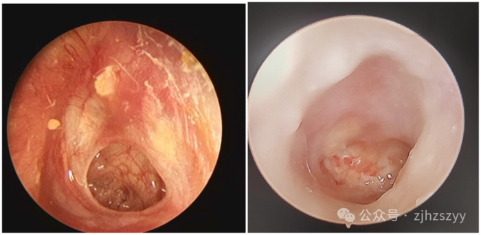 亲一口这个膜就破了一个月出现十多例专家提醒这些动作要谨慎