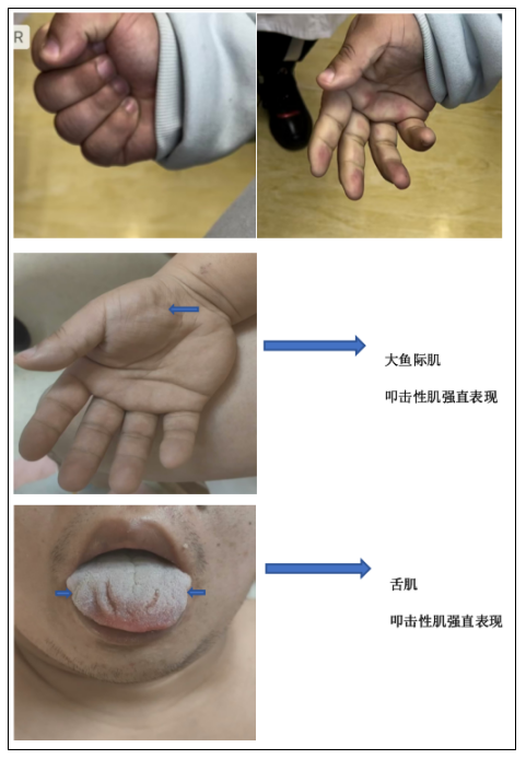 呼吸机怎么打开Ⅱ型呼吸衰竭又陷诊断困局……当室速撞上呼吸“牢笼”，如何通过破解隐匿的神经肌肉密码打开思路，拨云见日？丨疑案探密（161）_https://www.jmylbn.com_新闻资讯_第8张