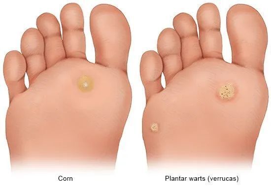 (左边是鸡眼,右边是跖疣,这么对比还是很明显的区别呢)跖疣和鸡眼如何