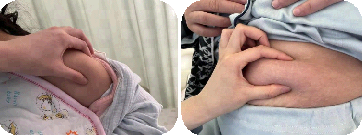 打肝素怎么拔针低分子肝素应该怎样注射？一文详细总结！_https://www.jmylbn.com_新闻资讯_第4张