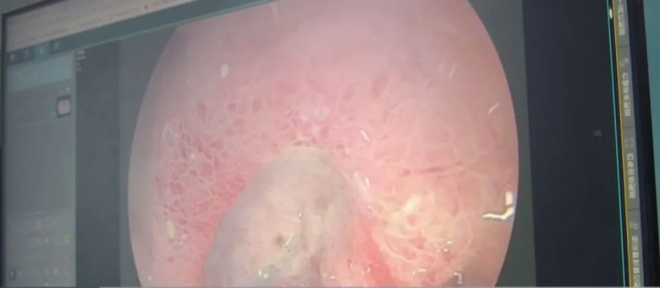 警惕!女子连吃两天竹笋致胃出血