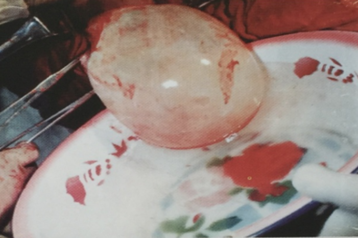 这种病被称为"虫癌"!幼虫主要寄生于肝脏