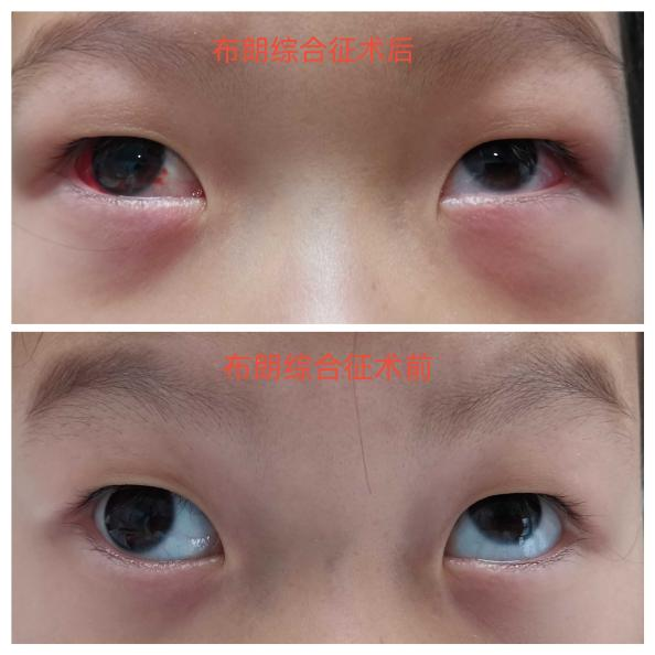 怀疑孩子有『斜视』!四大方法教您自查!