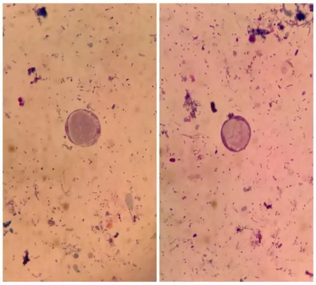 人芽囊原虫感染,你知多少?