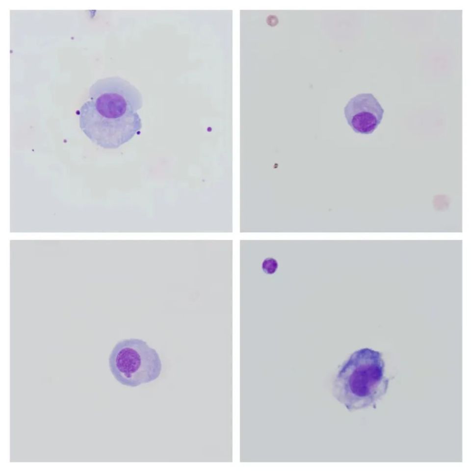 发热头痛呕吐,显微镜下见"真凶"