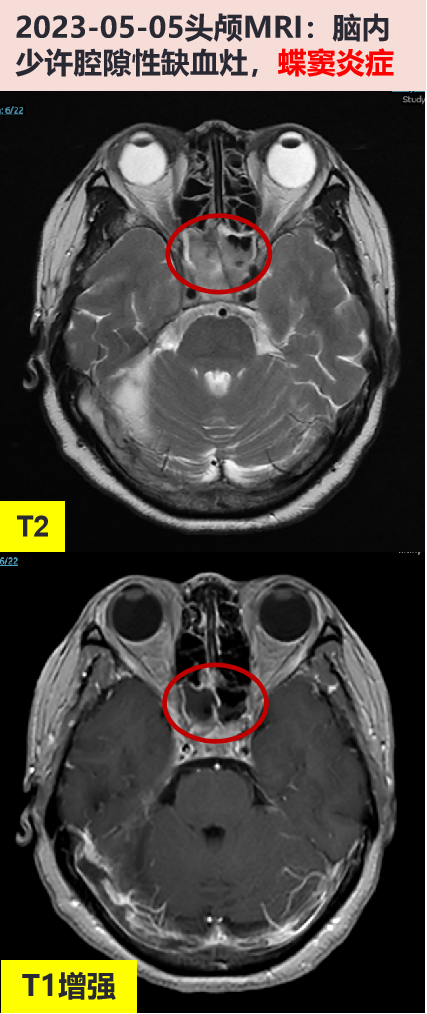 2023-05-05 头颅mri增强:脑内少许腔隙性缺血灶,蝶窦炎症