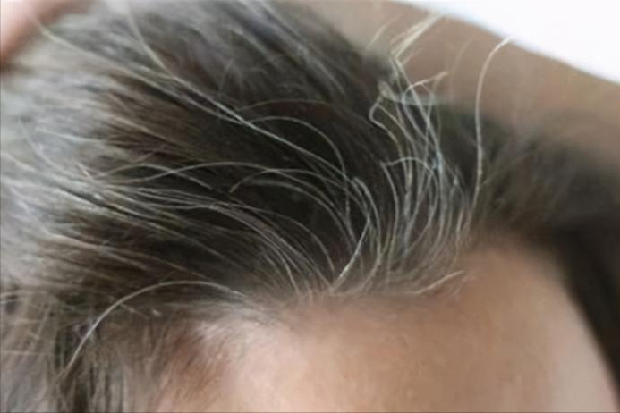 医生:白发不一定是老了,或跟这几个原因有关