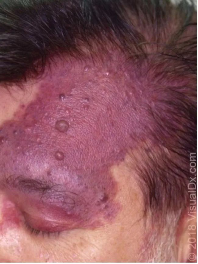 每年数以万计新生儿出现这种「红色胎记」,治疗要趁早!