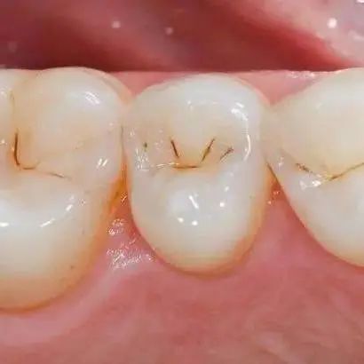位于牙冠部一般为釉质龋,位于牙颈部则是牙骨质龋或牙本质龋