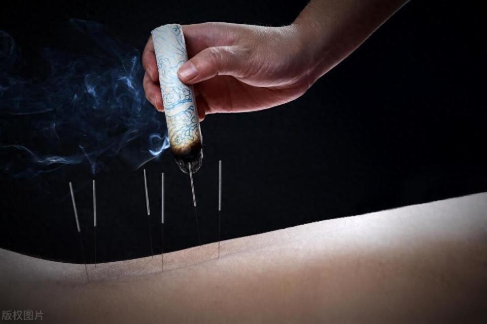吃药又怕有依赖性,其实中医针灸是个不错的选择_腾讯新闻