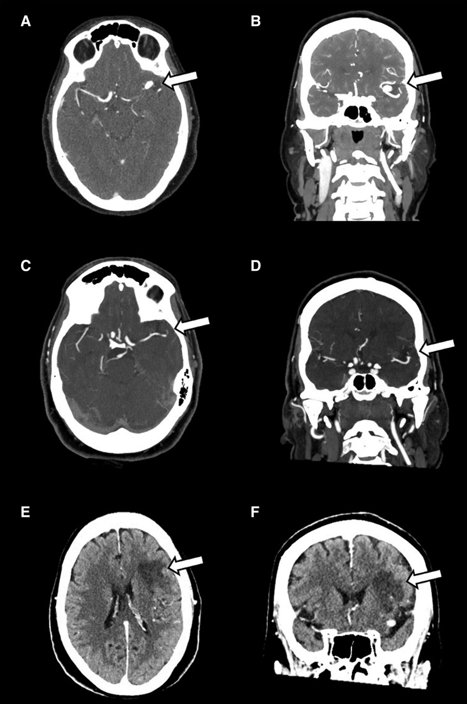图e和f,左侧m2上干梗死:平扫ct可见mca局部高密度信号为动脉瘤内血栓