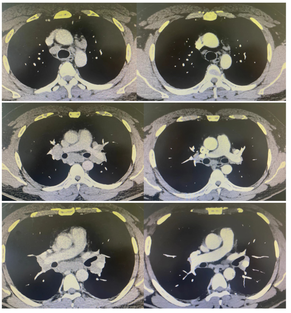淋巴结较前缩小(图4),头颅增强核磁共振可见脑膜占位较前相仿(图5)