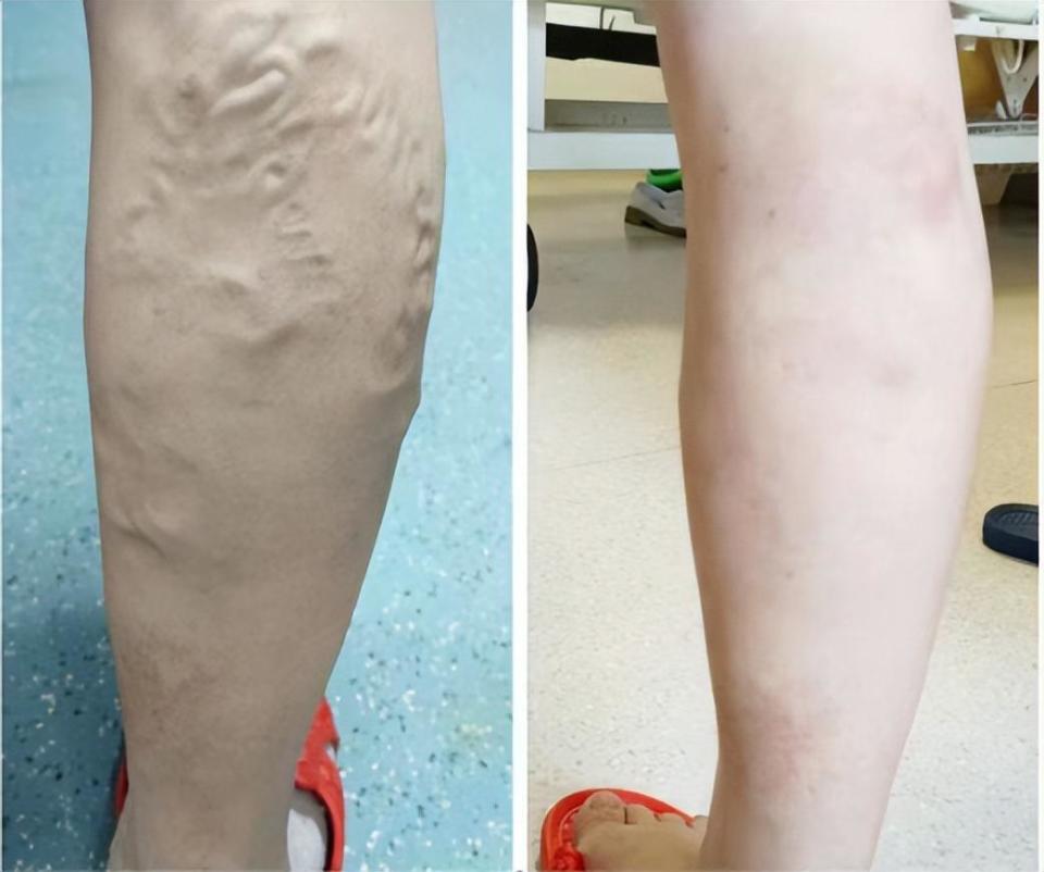 告别"蚯蚓腿",完美入夏天!这个手术帮您轻松解决下肢静脉曲张