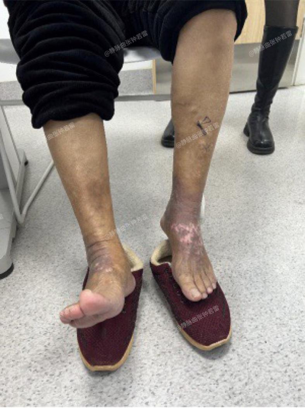 江夏婆婆脚踝皮肤发黑,自称就像穿了双"脱不下来的袜子"-腾讯新闻