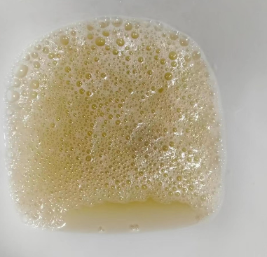 通过观察尿液,我们可以发现许多肾脏健康问题的早期信号.