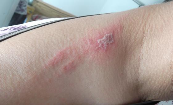 有人认为只要被隐翅虫叮咬就会患隐翅虫皮炎,其实不然.