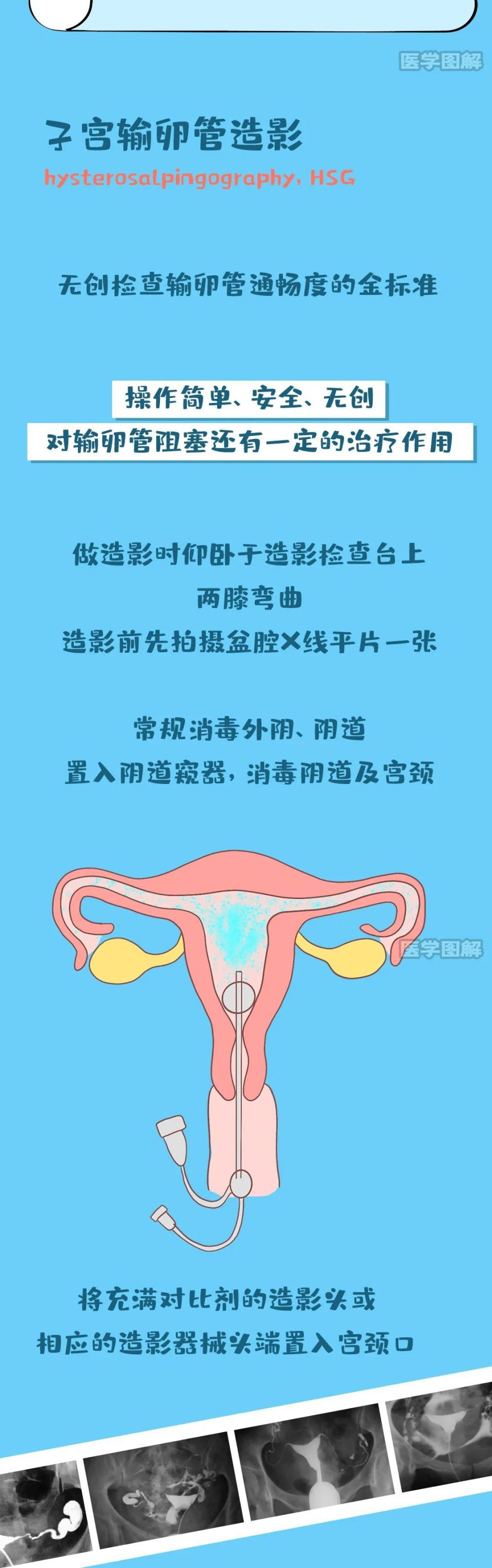 一图看懂输卵管造影丨医学图解