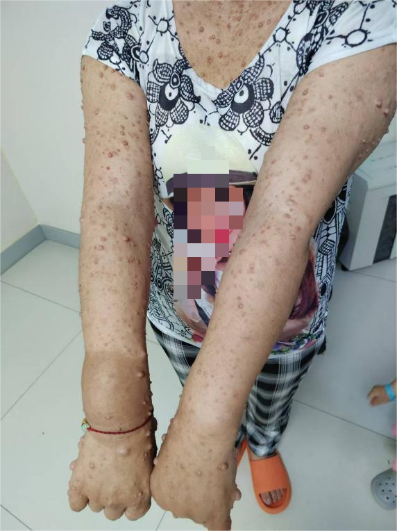 巨大肿物导致女童面部畸形?一个病例带你了解丛状神经纤维瘤