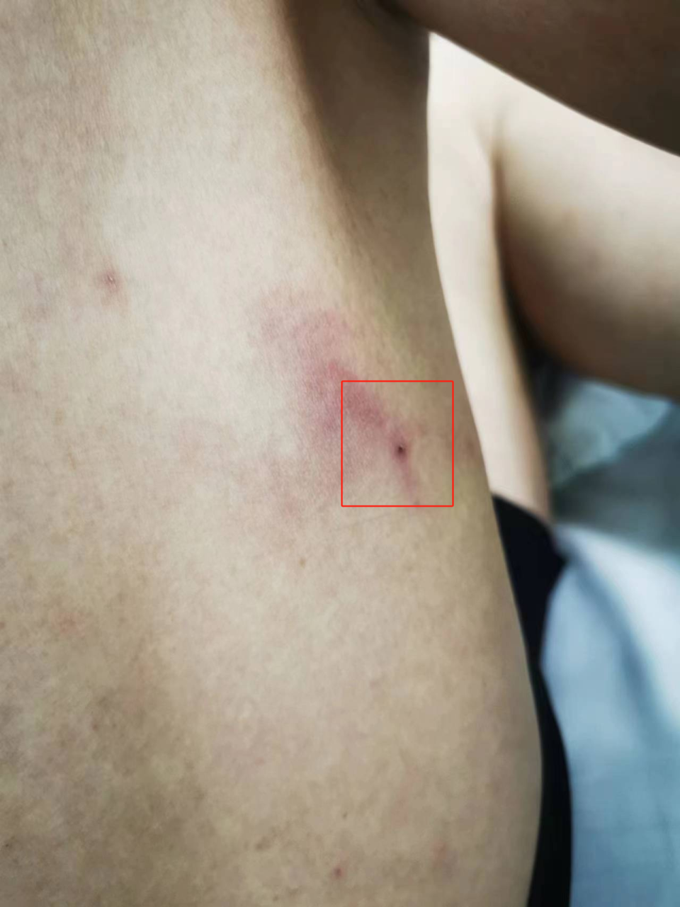 男子钓鱼被恙虫叮咬高烧40