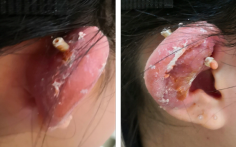 耳廓软骨膜炎初期可能仅表现为损伤部位的局部疼痛,皮肤红肿;后期炎症