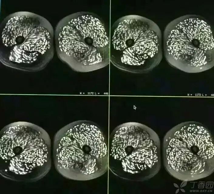 全身长满寄生虫图片