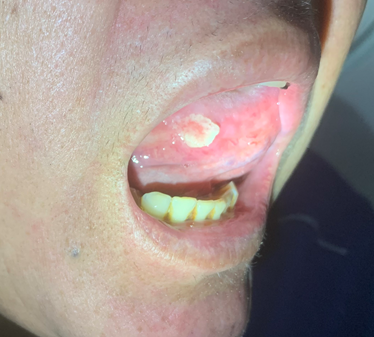 鲁东医讯口腔溃疡两个月竟转成了癌