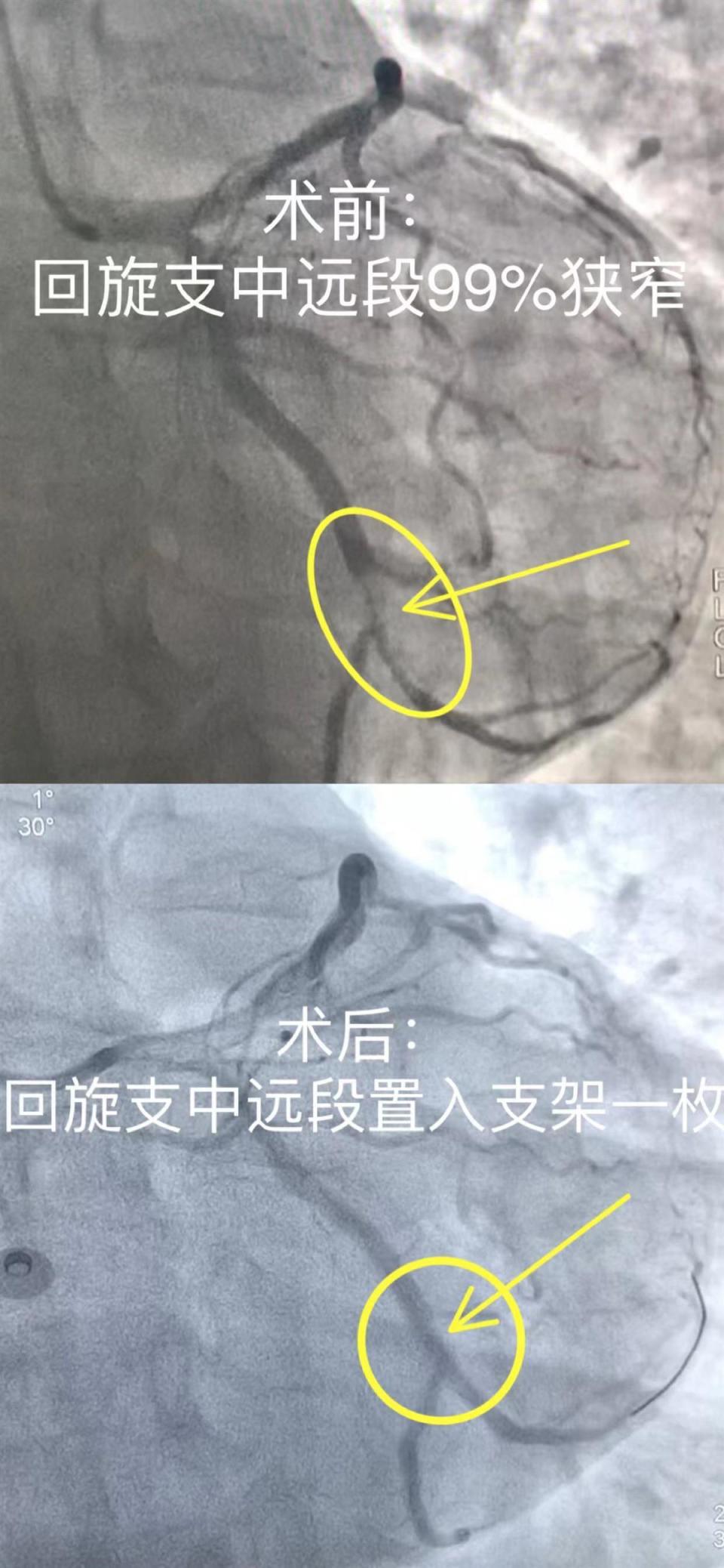 回旋支闭塞图片