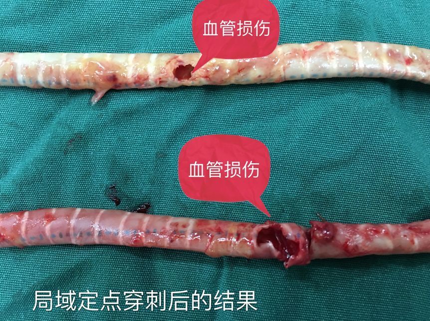 血液透析人造血管内瘘的穿刺管理要点 2024