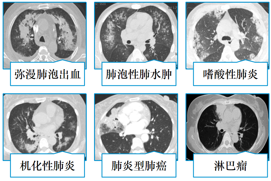 高莉教授:从呼吸科最常见的肺部感染基本影像,谈临床医生对影像学最易