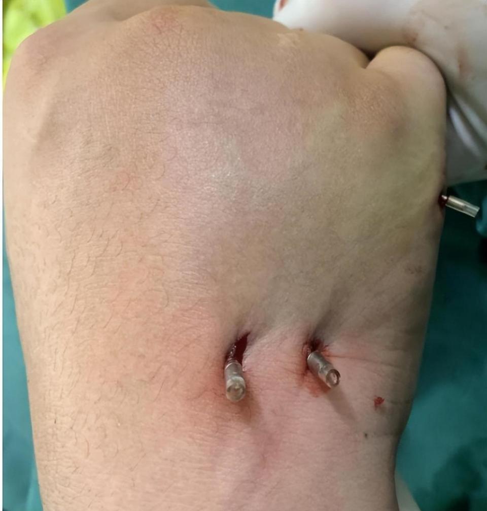 医生提醒:不要总以为你的拳头很硬