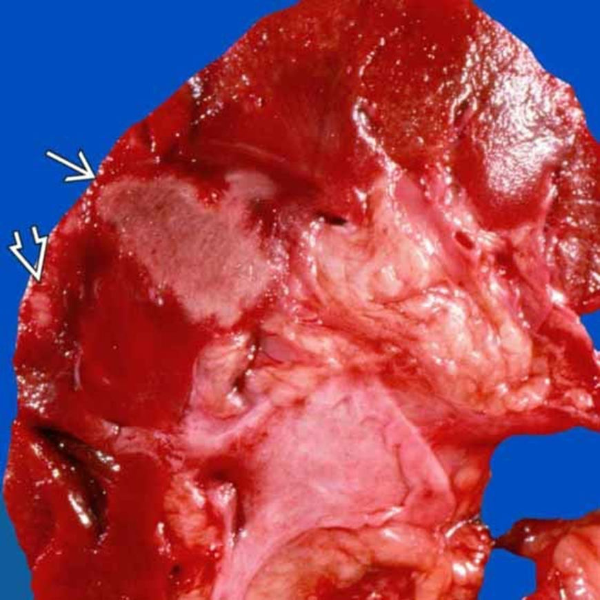 梗死:横截面肾脏切片显示大面积,苍白(缺血性)梗死(白色小箭头),边缘