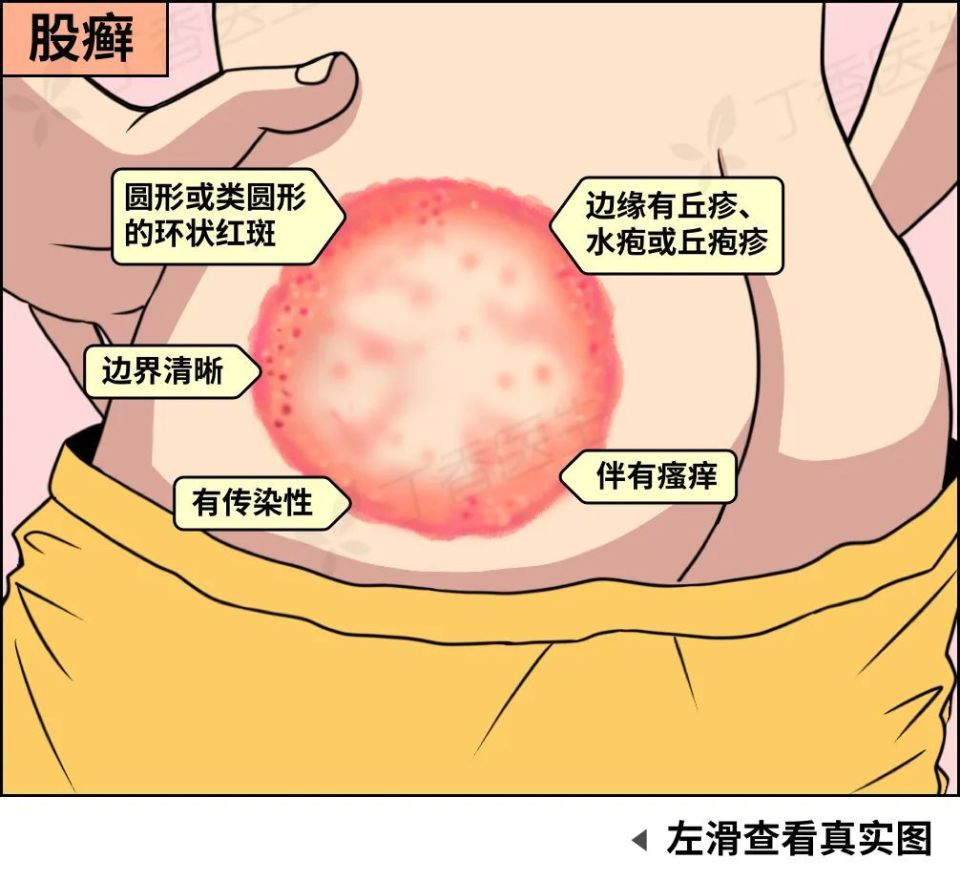 股癣怎么治疗图片