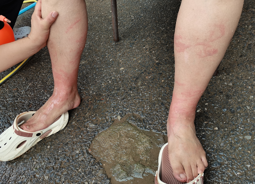 近期水母伤人多发,两天内蜇伤上百人