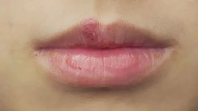唇膏过敏(唇膏过敏会出现什么症状)