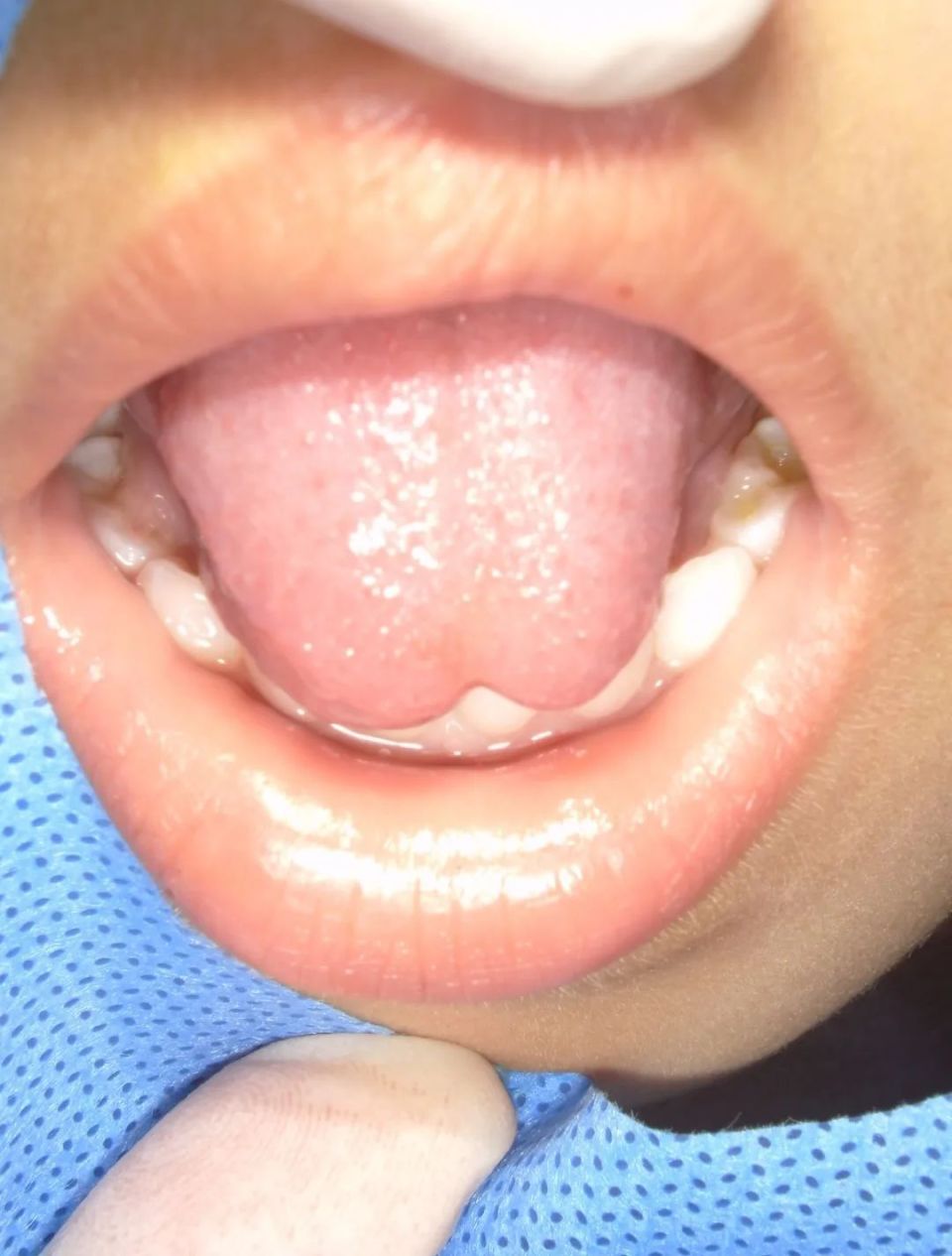 孩子说话不清就是舌系带过短一定需要手术治疗吗