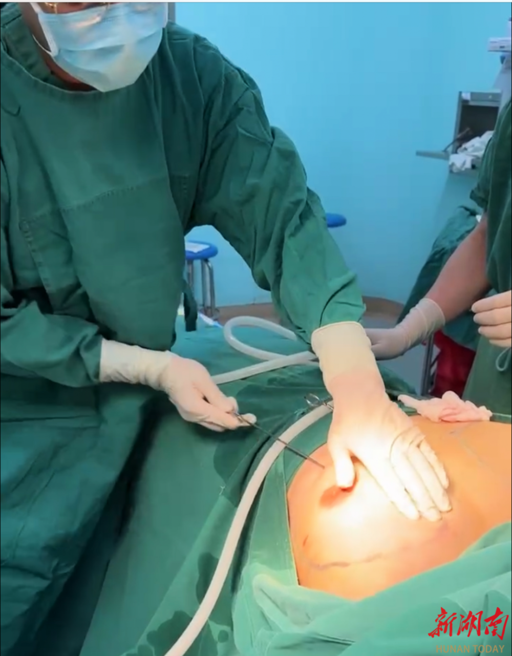 男言之隐蓝山县中心医院完成首例吸脂缩胸术解决男性乳房发育