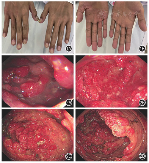 全身浅表淋巴结未及肿大,双手指甲,双足趾甲增厚,双手足掌侧色素沉着